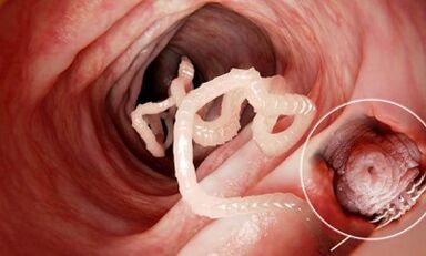 How to recognize the presence of parasites in human intestines